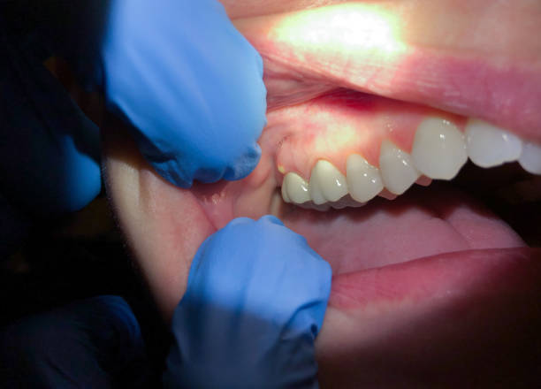 Best Emergency Treatment for Oral Infections in Gunbarrel, CO